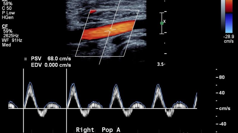 Diagnosing MALS The Role of Doppler Ultrasound CT Angiography and Other Imaging Studies