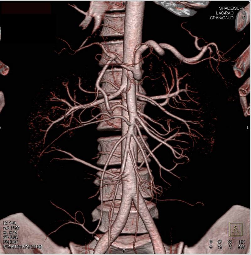 The Anatomy Involved Understanding the Celiac Artery and the Median Arcuate Ligament