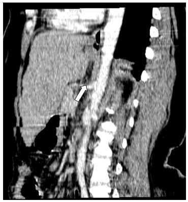 MALS Disease An In-depth Exploration