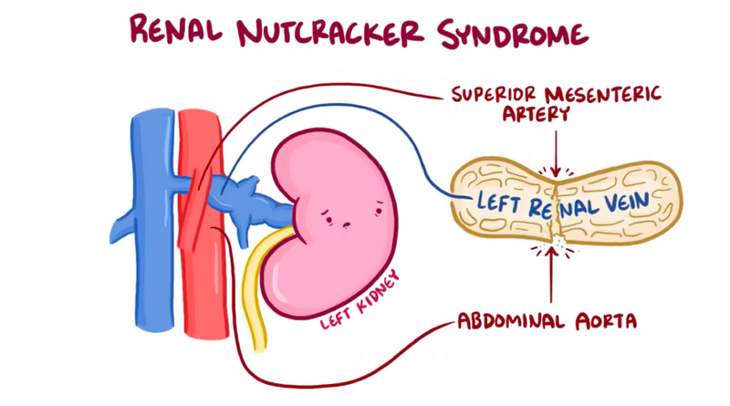 Pseudo Nutcracker Syndrome Myths Realities and Overlaps