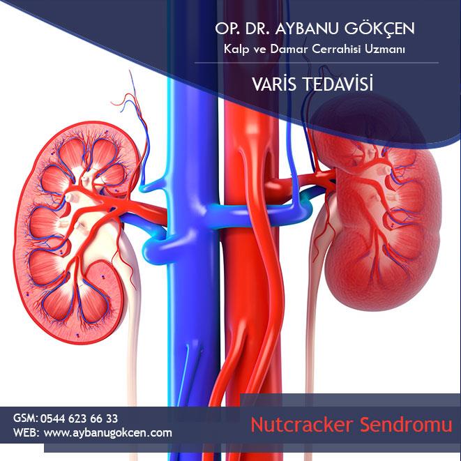 Understanding Nutcracker Syndrome in the Context of MALS